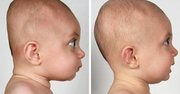 Chứng đầu bẹp làm việc trẻ sơ sinh Chứng đầu bẹp sinh sống trẻ sơ sinh