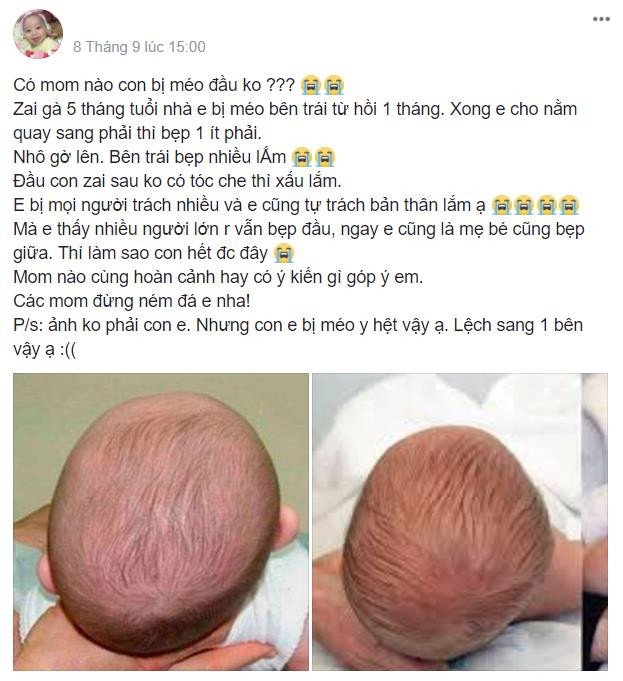 Cảnh báo con mon tuổi bị méo lệch đầu vì chị em chỉ mang lại nằm nghiêng Cảnh báo nhỏ tháng tuổi bị méo lệch đầu vì mẹ chỉ mang lại nằm nghiêng