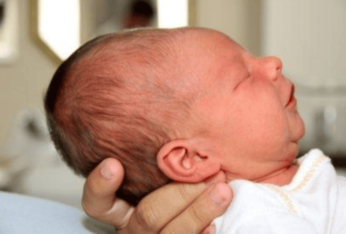 Trẻ sơ sinh đầu dài với bẹp Trẻ sơ sinh đầu dài với bẹp